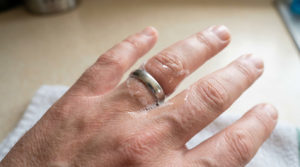 Close-up of a hand with a silver ring stuck on a swollen finger. White soap foam surrounds the ring, indicating a gentle removal attempt.